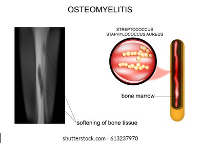 vector illustration of bone lesions osteomyelitis
