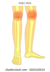 Vector illustration of bones of a human legs (anterior and medial view) with knee joint pain or injury. For advertising, medical (health care) publications. EPS 10