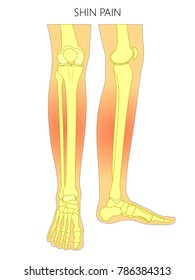 Vector illustration of bones of a human legs (anterior and medial view) with shin pain. Vector illustration for advertising, medical (health care) publications. EPS 10