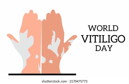 Vector illustration, Both hands affected by vitiligo, as a banner or poster, world vitiligo day. June.