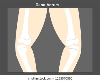 Vector Illustration Bowed Legs. Genu Valgum.