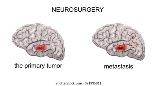 Vector Illustration Of A Brain Tumor. Metastasis. Neurosurgery
