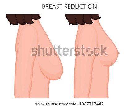 plastic surgeons breast reduction Plastic surgeons breast reduction