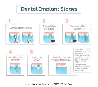 Vector illustration with a brochure, leaflet or poster with a Memo and Recommendations for Patients undergoing Dental Implantation at the Dentist. The sequence and Steps of Implantation are shown.