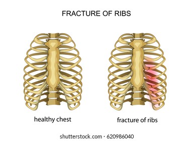 vector illustration of broken ribs chest thorax
