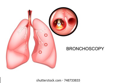 Vector Illustration Of A Bronchoscopy Of The Lungs, Sectional View
