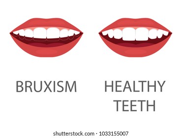 vector illustration of bruxism. grinding of teeth. tooth appliance. dental care. dentistry health problem