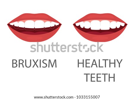 vector illustration of bruxism. grinding of teeth. tooth appliance. dental care. dentistry health problem