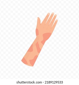 Vector illustration of burns on hands. Colored vector for website design .Simple design on transparent background (PNG).