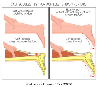 Vector illustration of a calf squeeze test Achilles tendon rupture. External and Skeletal view of an ankle. Used: Gradient, transparency, blend mode.