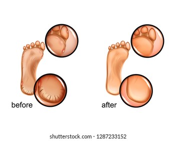 vector illustration of a calluses and cracked heels