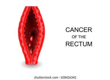 vector illustration of cancer of the rectum