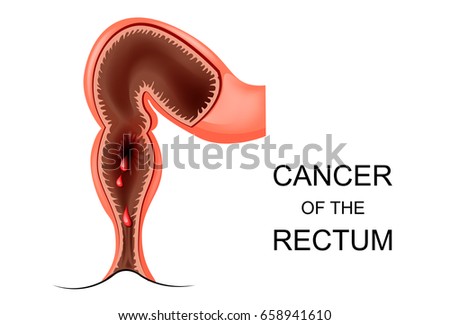 vector illustration of cancer of the rectum