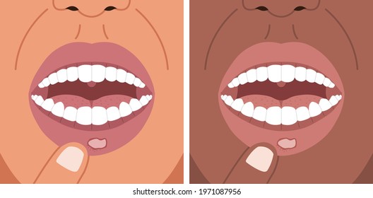 Vector Illustration Canker Sore, Aphthous Ulcer On The Lip, Stomatitis.