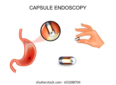 Vector Illustration Of Capsule Endoscopy. EGD, Gastroenterology. 2
