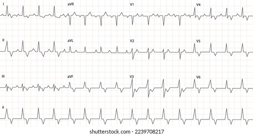 Vector illustration of a cardiogram. Transparent background with a heartbeat line. Medication, pulse, electrocardiogram, heart rate.