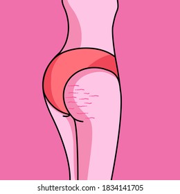 vector illustration of cartoon , Butt Stretch Marks , female body , 