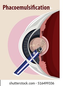 Vector Illustration Of  Cataract Surgery 