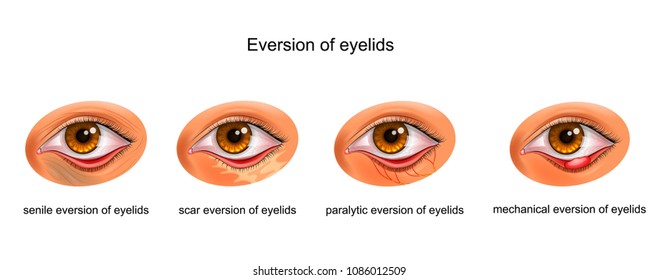 vector illustration of the cause of the eyelid