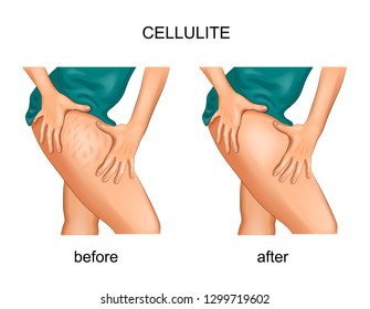 vector illustration of cellulite on a woman's thigh