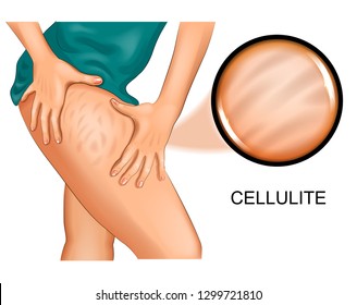 Vector Illustration Of Cellulite On A Woman's Thigh