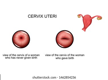 Vector Illustration Of Cervix Before And After Childbirth