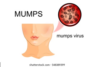 vector illustration of child affected by mumps. for publications in medical brochures