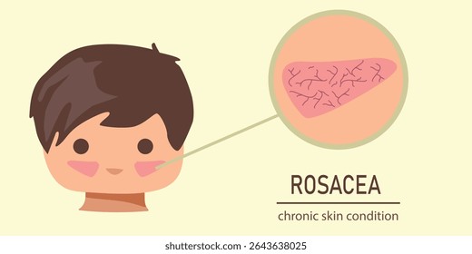 Ilustração vetorial de uma criança com vermelhidão facial causada por rosácea, mostrando textura vascular da pele e condição crônica