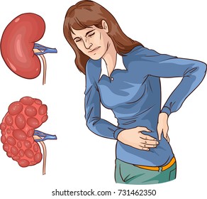  vector illustration of a Chronic kidney disease