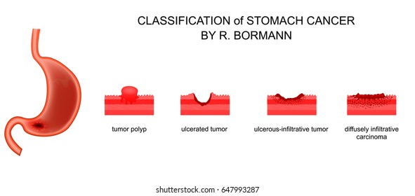 Vector Illustration Of Classification Of Gastric Cancer