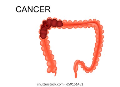 vector illustration of colon cancer is a sectional view
