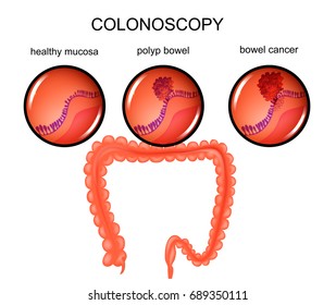 Vector Illustration Of A Colon Polyp And Cancer
