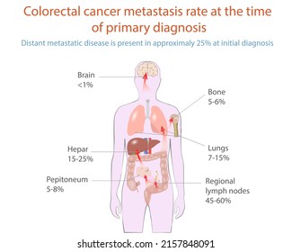 Vector Illustration Of Colorectal Cancer Metastasis, Medical Diagram