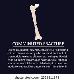 Ilustración vectorial de una fractura conminuta