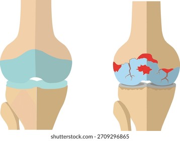 Ilustración vectorial para comparar una articulación de rodilla sana versus una rodilla con osteoartritis