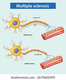 Vector illustration comparing healthy and multiple sclerosis-affected neurons, showing myelin sheath damage and signal disruption.