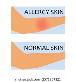 vector illustration comparison of allergen on arm and normal skin arm. Acne, allergy, dermatitis, eczema, skin irritation, itchy, dermatology. Isolated on white background