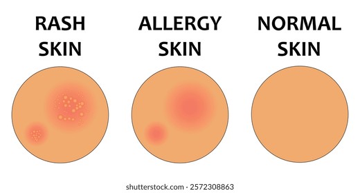 vector illustration of comparison of rash skin, allergy skin, and normal skin. Acne, allergy, dermatitis, eczema, skin irritation, itchy, dermatology. Isolated on white background