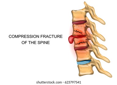 Vector Illustration Of A Compression Fracture Of The Spine
