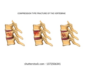 Vector Illustration Of A Compression Type Fracture Of The Spine