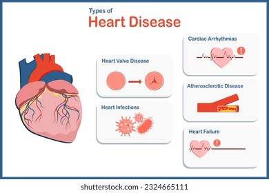 vector Illustration concept for medicine type of heart disease,Atherosclerotic Disease,Cardiac Arrhythmias,Heart Valve Disease,Heart Infections, Heart Failure.flat style.