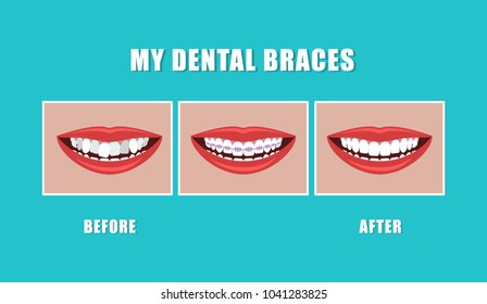 Vector illustration. Concept of the work of dental braces. Beautiful smile.