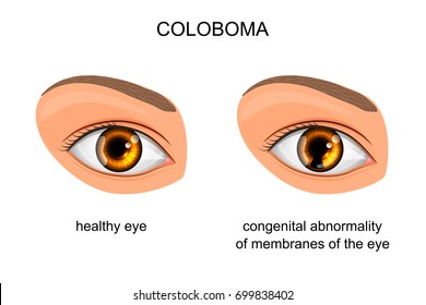 vector illustration of congenital disorder of membranes of the eye. coloboma