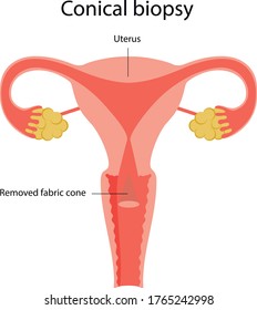 Ilustración vectorial de una biopsia cónica de un útero femenino. Cono de tejido eliminado