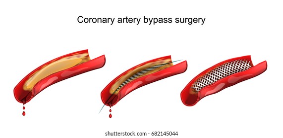vector illustration of coronary artery bypass vessels