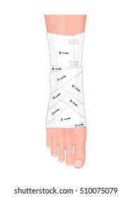 Vector illustration. Correct way to wrap an ankle by flexible elastic supportive orthopedic bandage (sprain, strain).