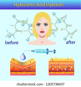 Vector illustration with cosmetic filler or Dermal fillers on light background