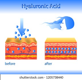 Vector illustration with cosmetic filler or Hyaluronic acid on light background