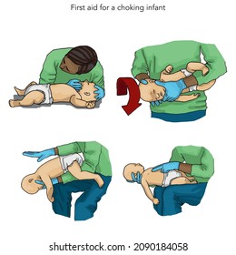 Vector illustration - CPR for baby or infant, first aid measures kid, basic help. - CPR infant by 2 thumbs, first aid measures kid