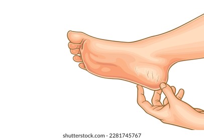 Vector illustration of cracked dry skin on woman's heels,wounds,pain when walking,peeling skin,dehydrated skin on heels of female feet,isolated on white background.Health care,Skin care feet.